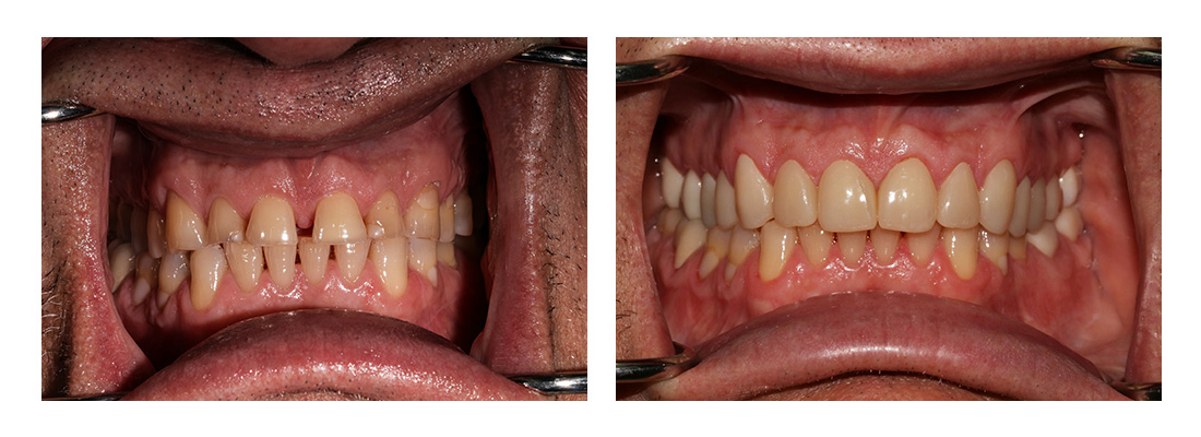 iSmile Dental Group | Dental Bridges, Night Guards and Root Canals