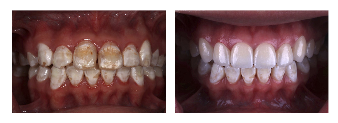 iSmile Dental Group | CEREC, Ceramic Crowns and Dental Fillings
