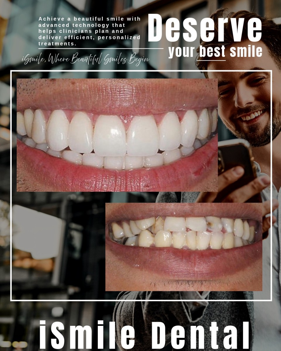 iSmile Dental Group | Fluoride Treatment, Ceramic Crowns and Dentures