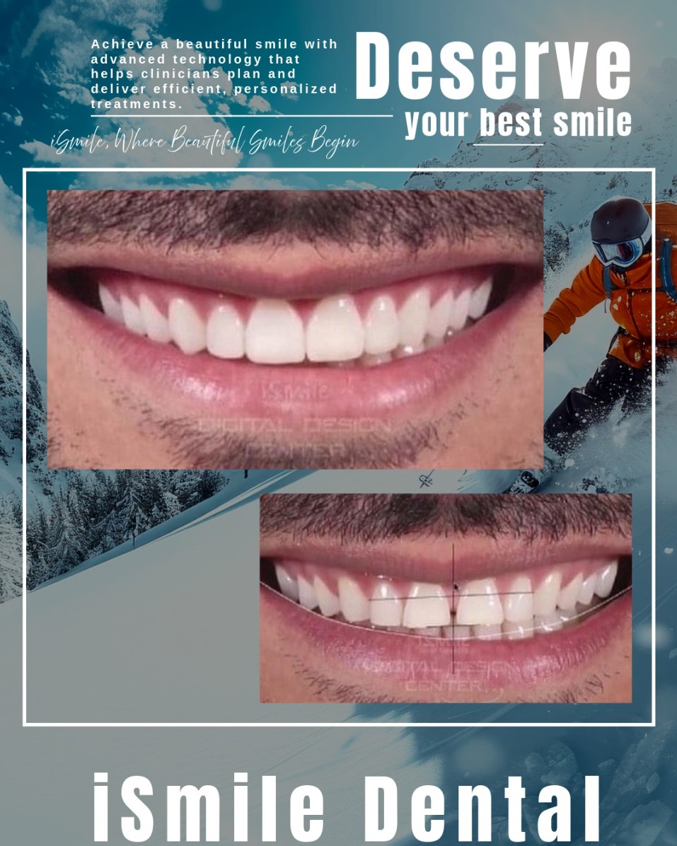 iSmile Dental Group | Fluoride Treatment, ClearCorrect reg  and Ceramic Crowns