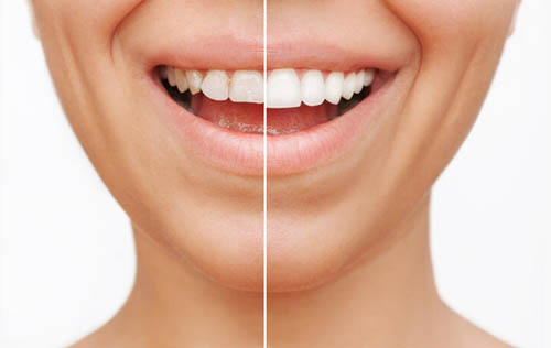 iSmile Dental Group | Root Canals, Night Guards and Full Mouth Reconstruction