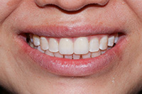 iSmile Dental Group | CEREC, Ceramic Crowns and Dental Fillings