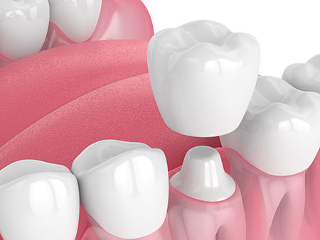 iSmile Dental Group | Fluoride Treatment, Teeth Whitening and Invisalign reg 