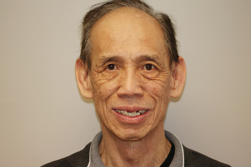 image of old man after treatment image of old man after treatment