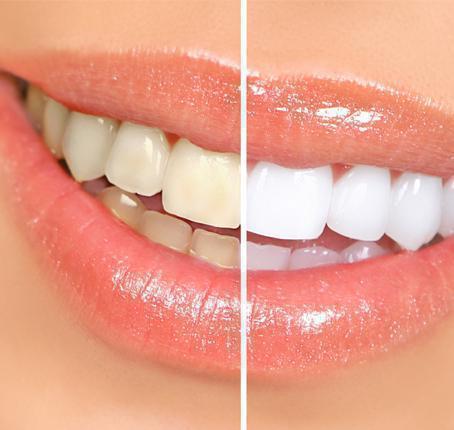 Teeth Whitening Teeth Whitening