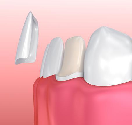 Veneers Veneers